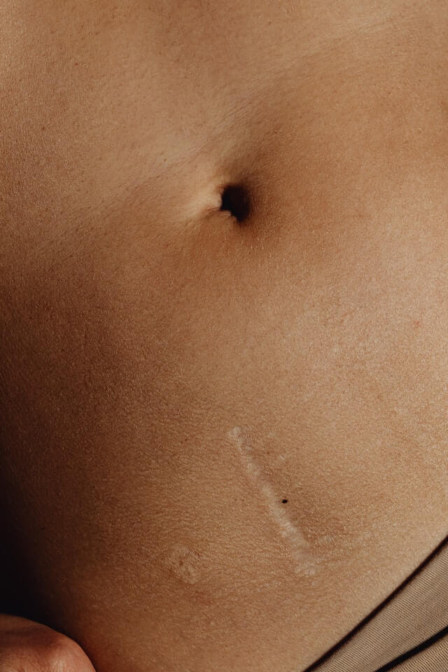 Scar Removal Treatment on Woman